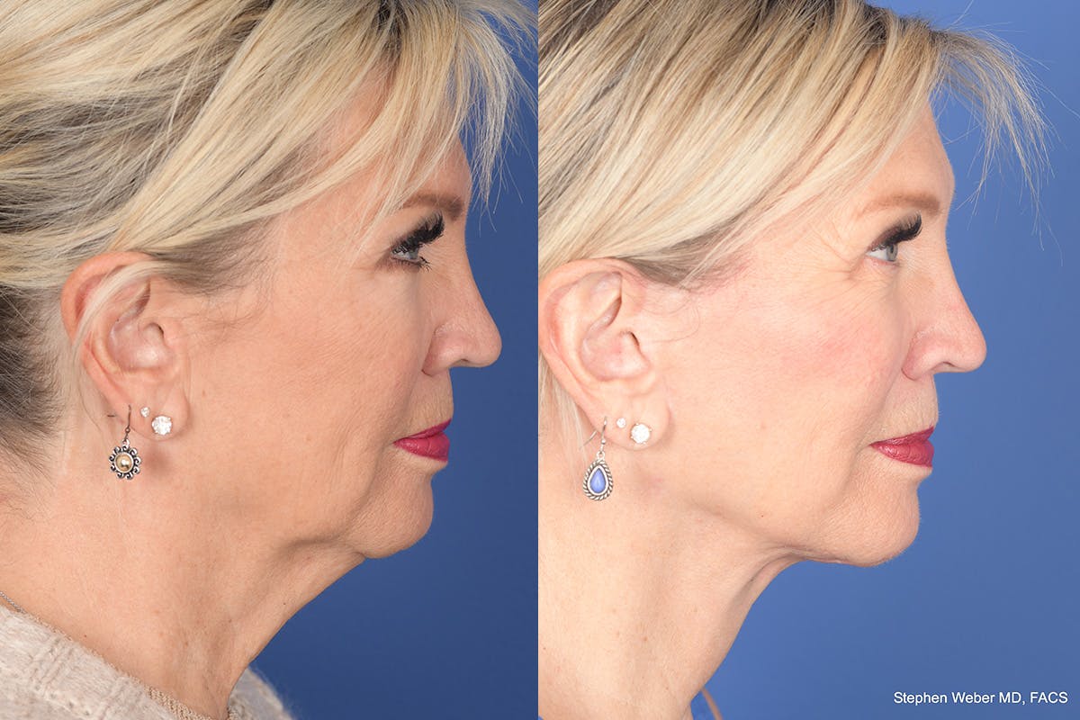 Facelift Before & After Gallery - Patient 395824 - Image 5