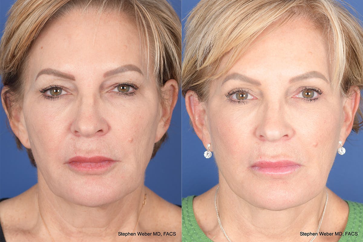 Facelift Before & After Gallery - Patient 449422 - Image 1