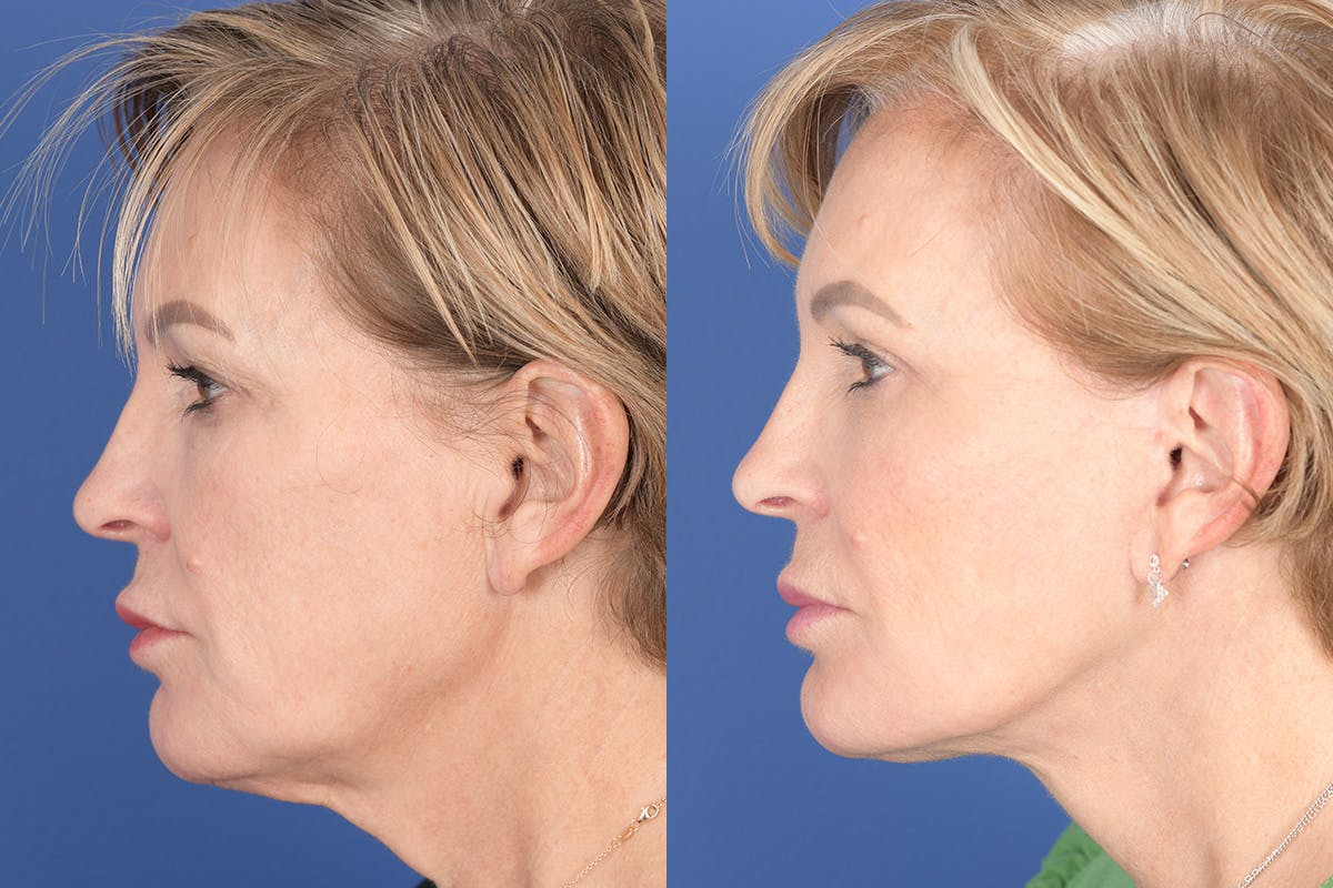 Facelift Before & After Gallery - Patient 449422 - Image 2