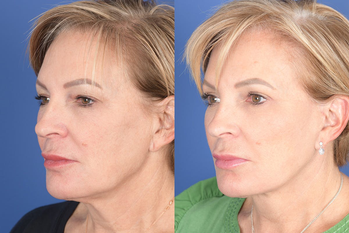 Facelift Before & After Gallery - Patient 449422 - Image 3
