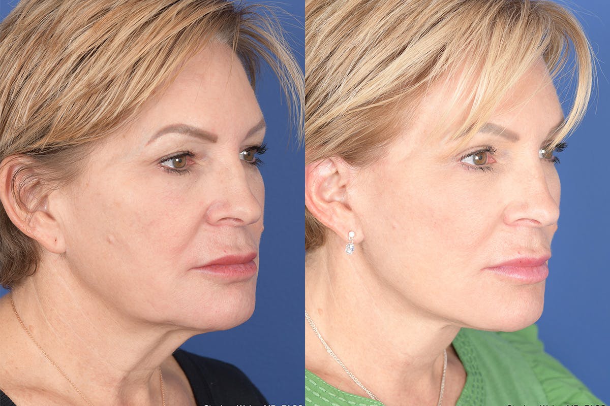 Facelift Before & After Gallery - Patient 449422 - Image 4