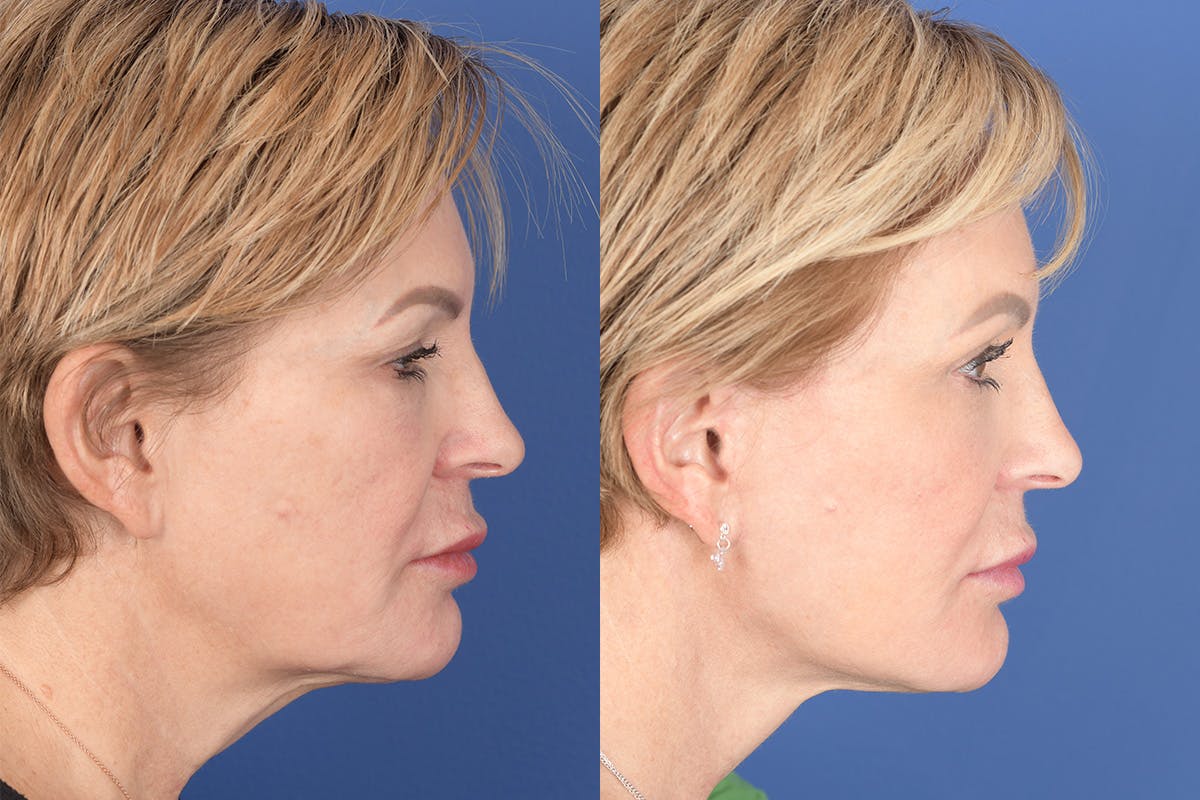 Facelift Before & After Gallery - Patient 449422 - Image 5