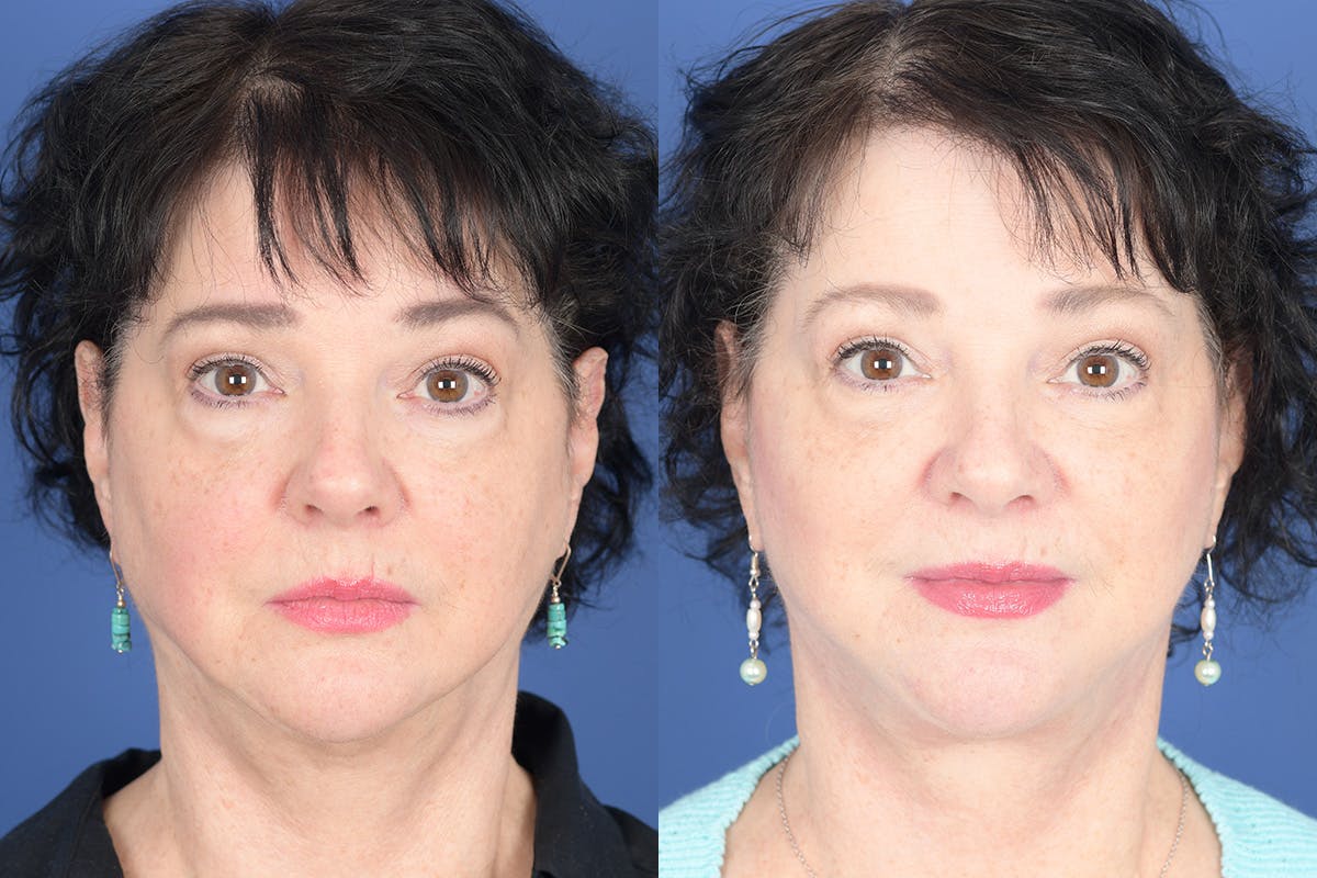 Facelift Before & After Gallery - Patient 530931 - Image 1