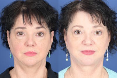 Facelift Before & After Gallery - Patient 530931 - Image 1
