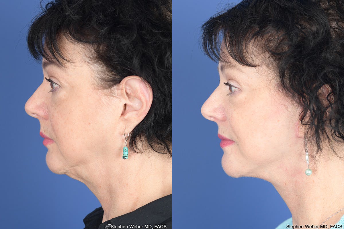 Facelift Before & After Gallery - Patient 530931 - Image 2