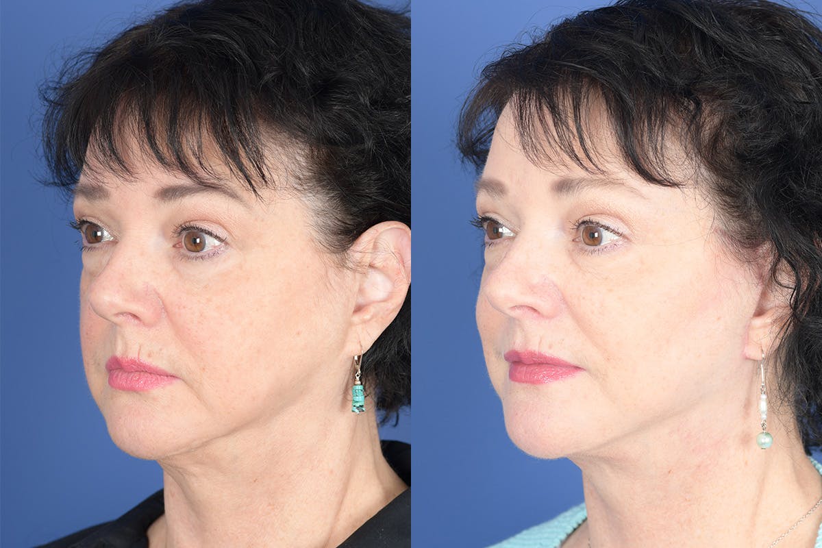 Facelift Before & After Gallery - Patient 530931 - Image 3