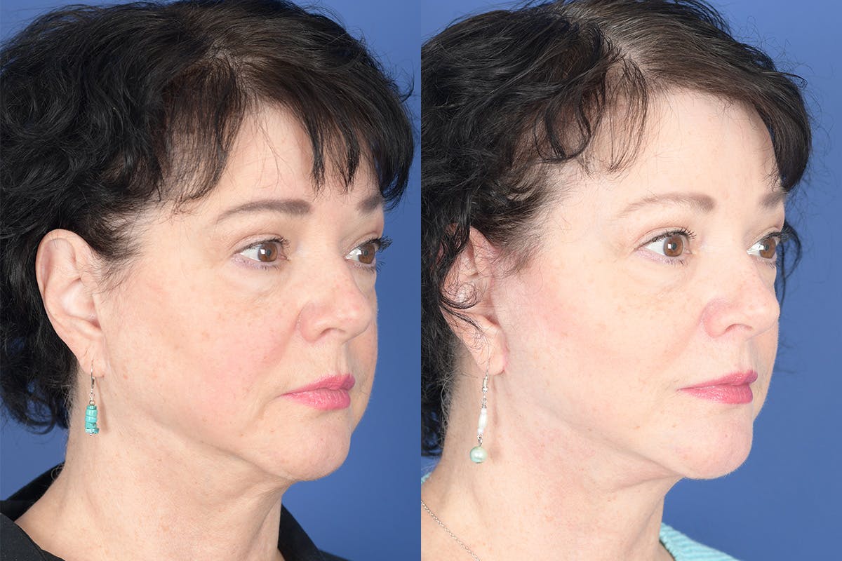 Facelift Before & After Gallery - Patient 530931 - Image 4