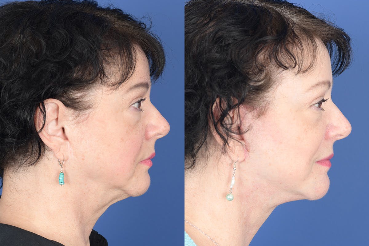 Facelift Before & After Gallery - Patient 530931 - Image 5
