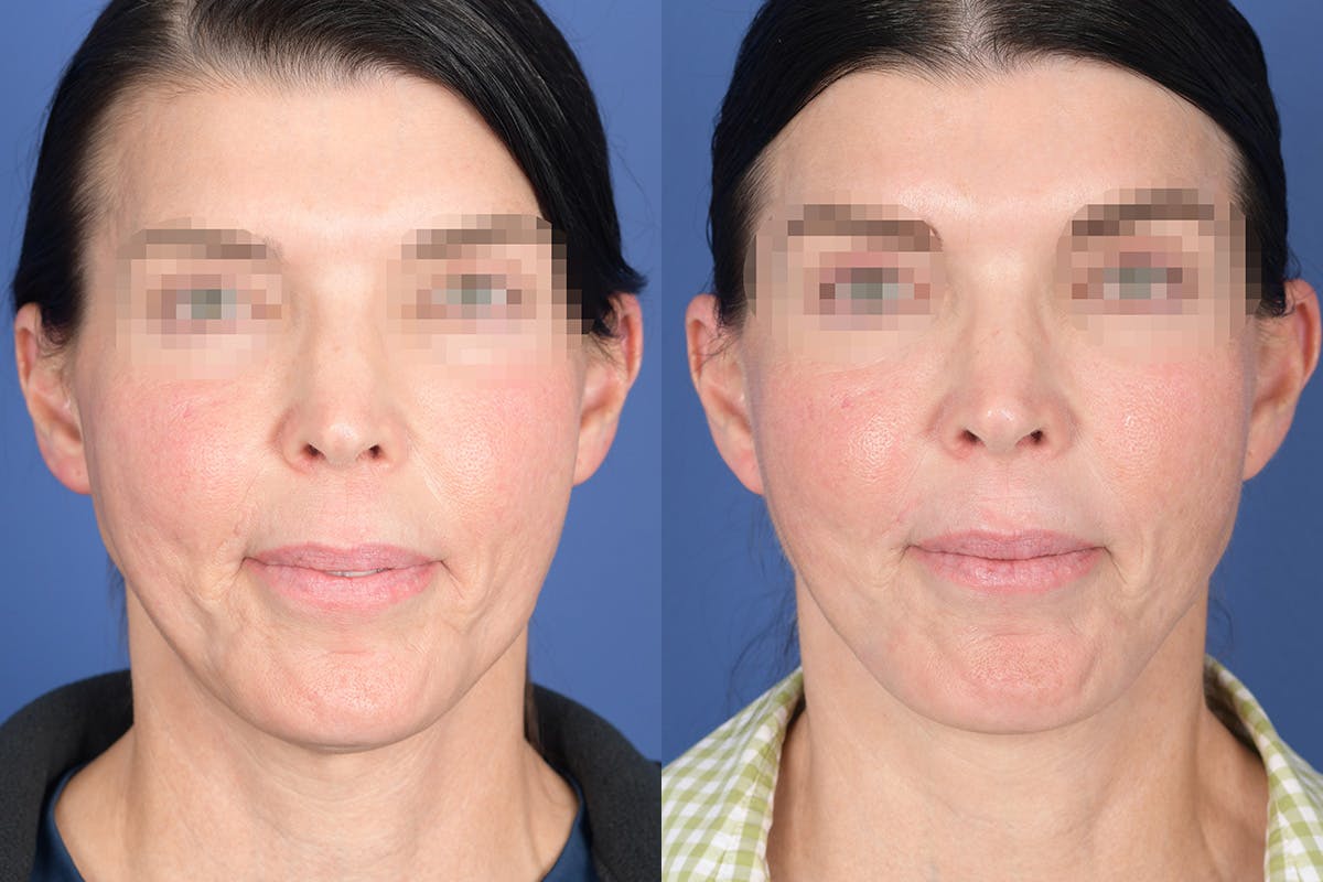 Facelift Before & After Gallery - Patient 490301 - Image 1