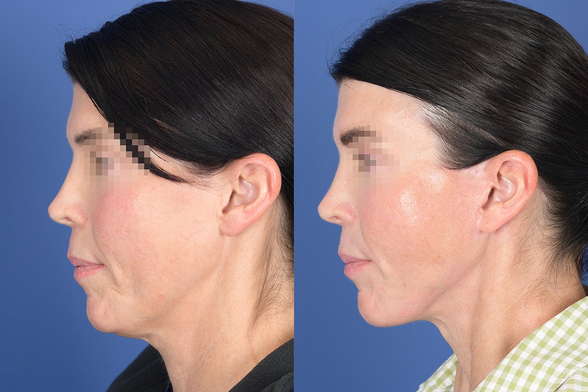 Facelift Before & After Gallery - Patient 490301 - Image 2