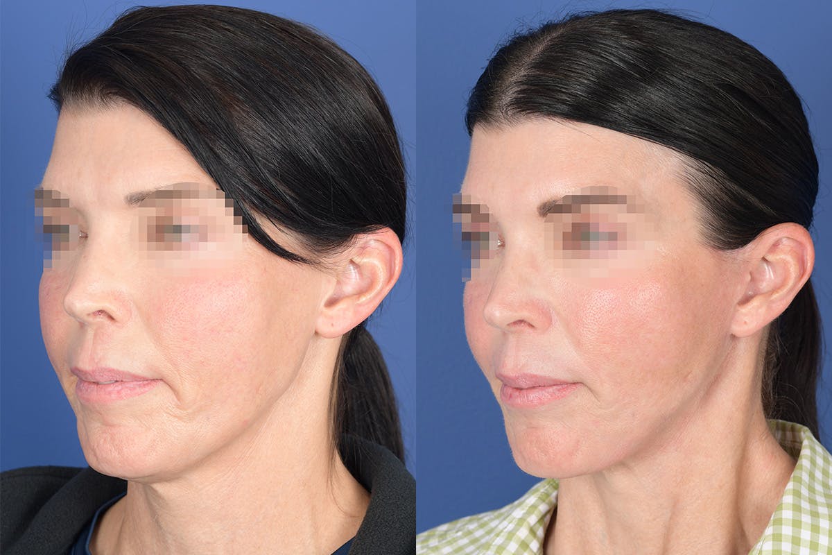 Facelift Before & After Gallery - Patient 490301 - Image 3