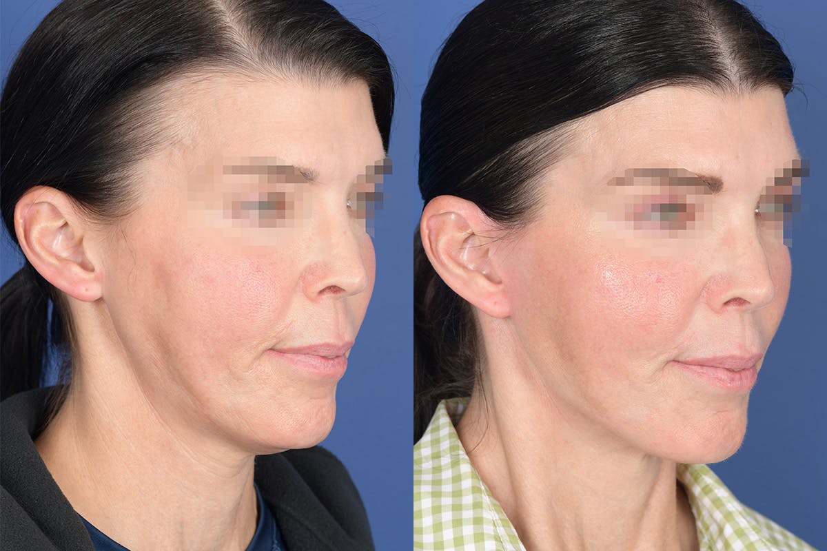 Facelift Before & After Gallery - Patient 490301 - Image 4