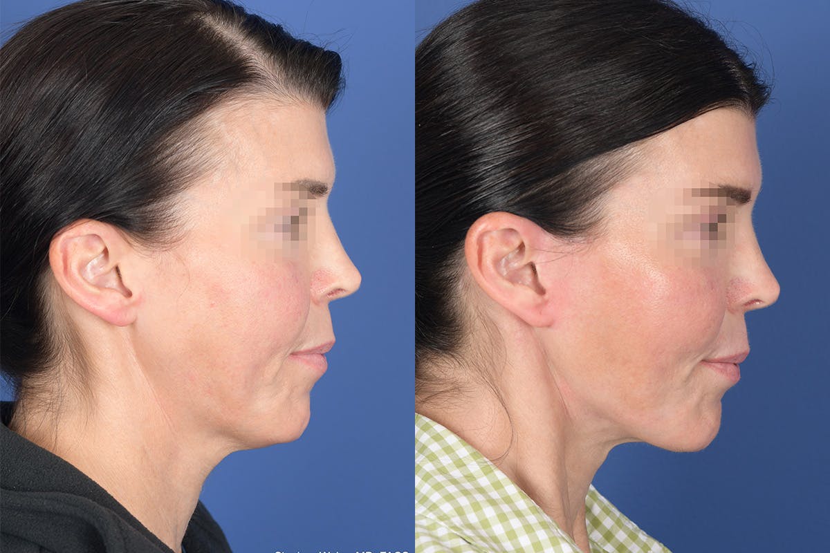 Facelift Before & After Gallery - Patient 490301 - Image 5