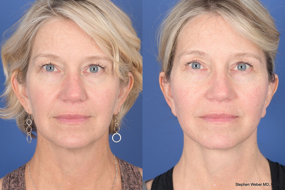 Necklift Before & After Gallery - Patient 143897 - Image 1