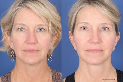Facelift Before & After Gallery - Patient 922186 - Image 1