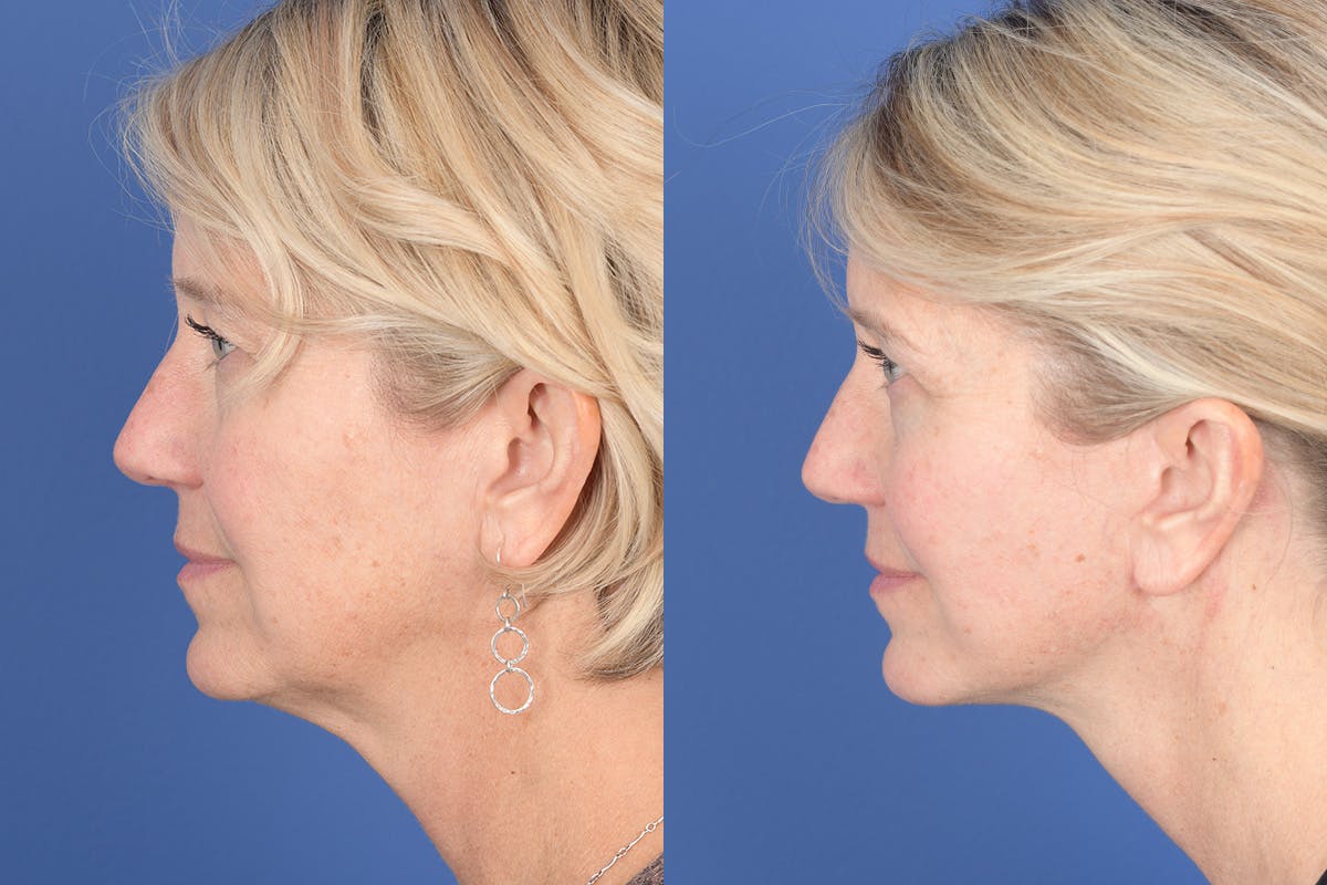 Necklift Before & After Gallery - Patient 143897 - Image 2