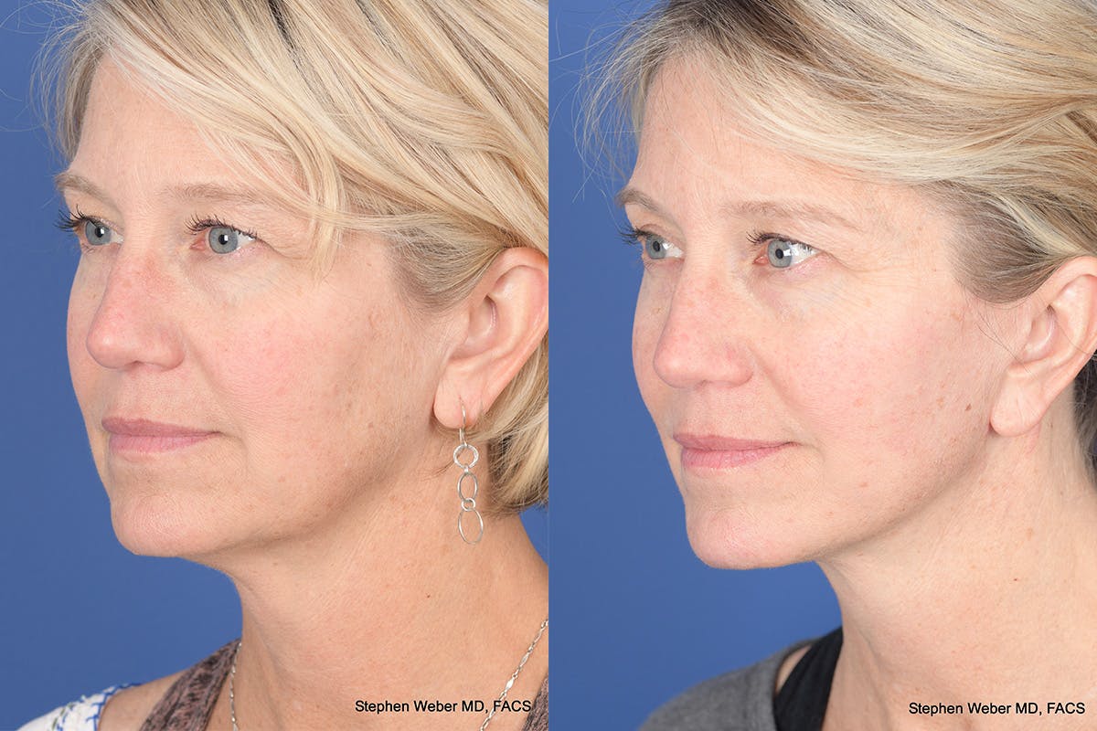 Necklift Before & After Gallery - Patient 143897 - Image 3