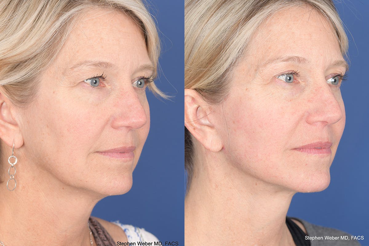 Necklift Before & After Gallery - Patient 143897 - Image 4