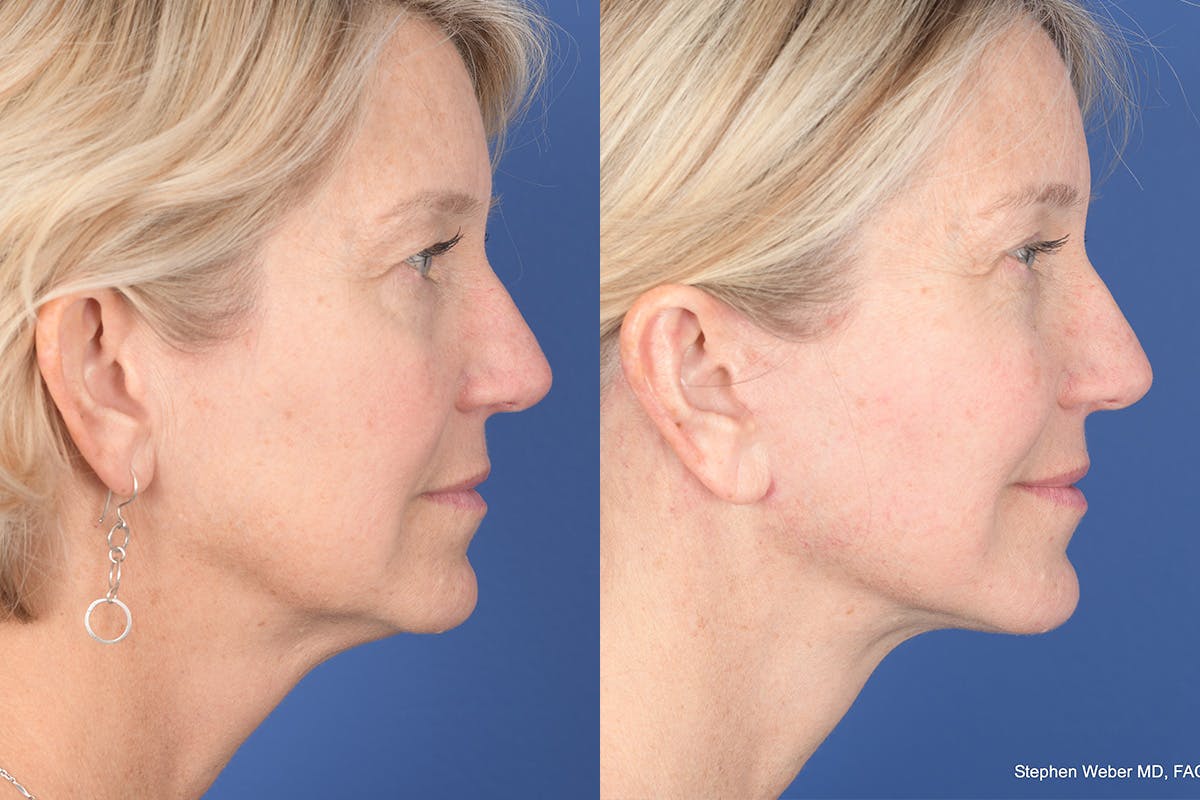 Necklift Before & After Gallery - Patient 143897 - Image 5