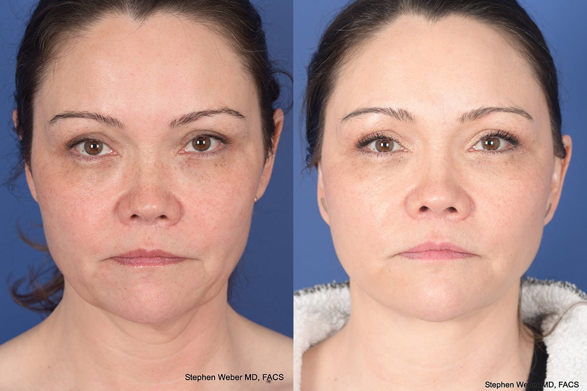 Facelift Before & After Gallery - Patient 802311 - Image 1