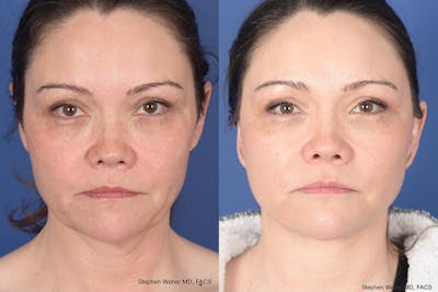 Facelift Before & After Gallery - Patient 802311 - Image 1