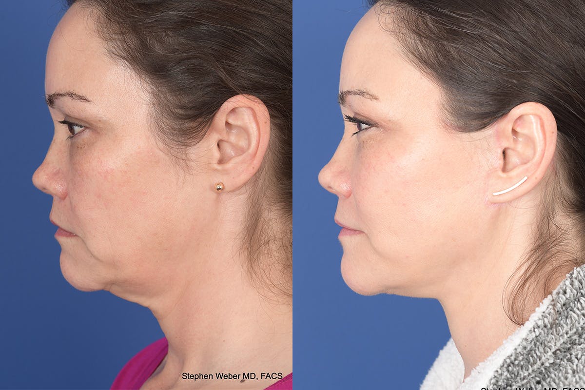 Facelift Before & After Gallery - Patient 802311 - Image 2