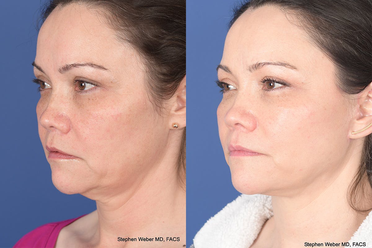 Facelift Before & After Gallery - Patient 802311 - Image 3