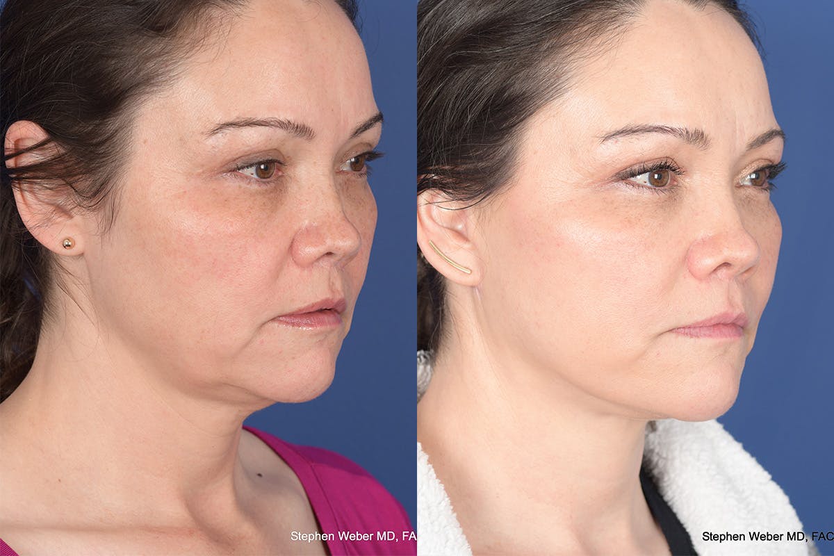 Facelift Before & After Gallery - Patient 802311 - Image 4