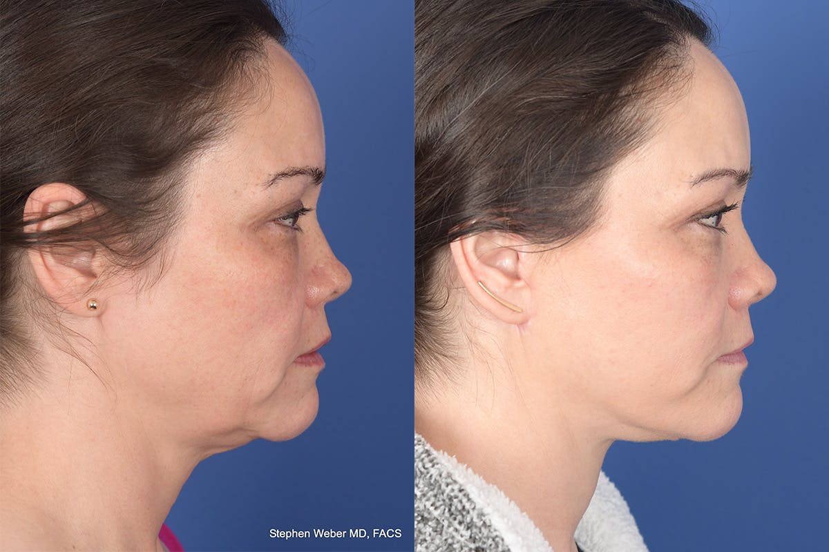 Facelift Before & After Gallery - Patient 802311 - Image 5