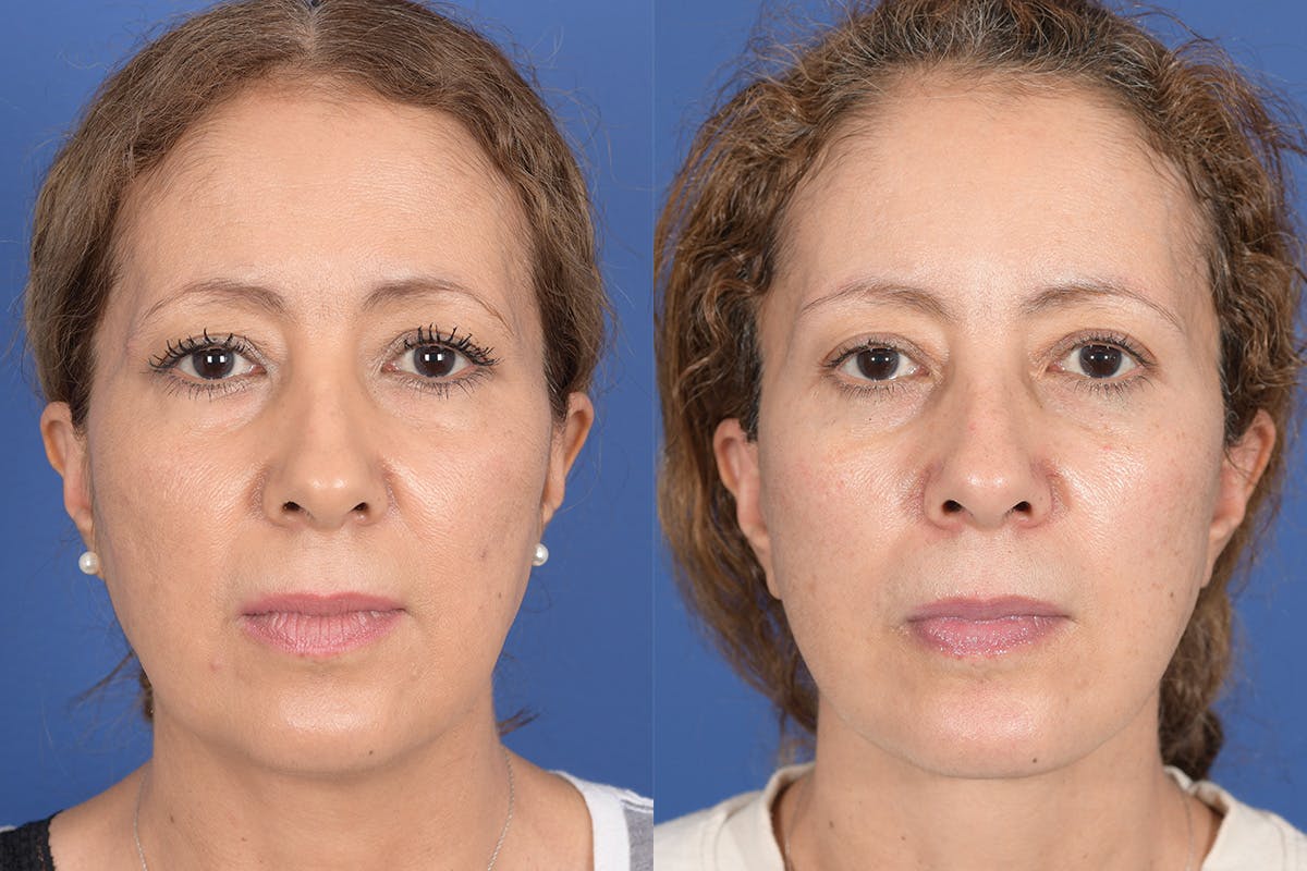 Facelift Before & After Gallery - Patient 352764 - Image 1