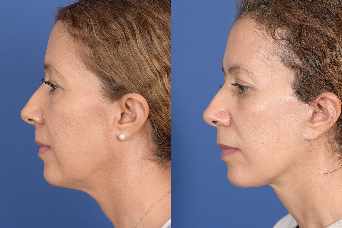 Facelift Before & After Gallery - Patient 352764 - Image 2