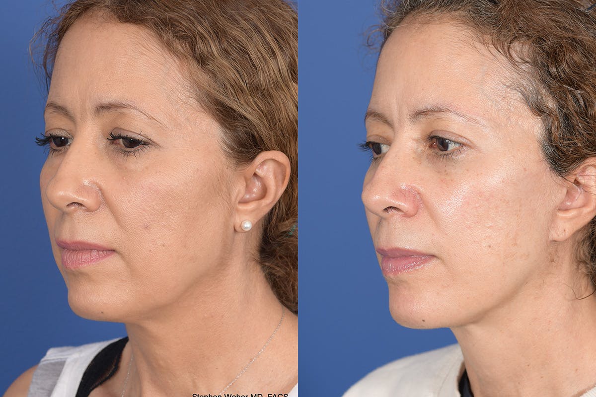 Facelift Before & After Gallery - Patient 352764 - Image 3