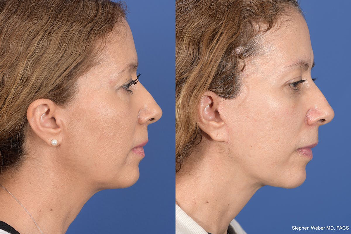 Facelift Before & After Gallery - Patient 352764 - Image 5