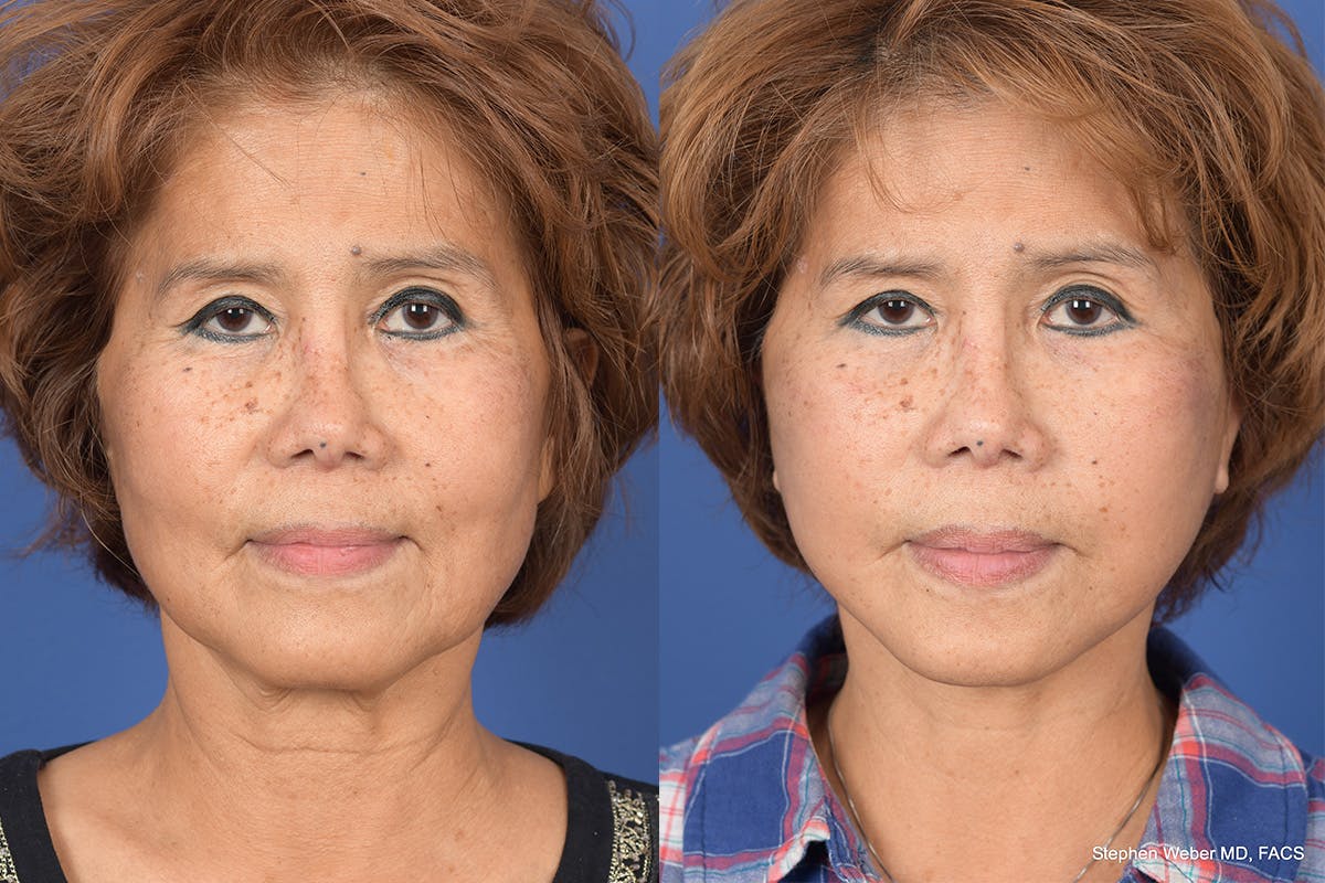 Facelift Before & After Gallery - Patient 306298 - Image 1