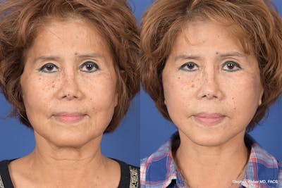 Facelift Before & After Gallery - Patient 306298 - Image 1