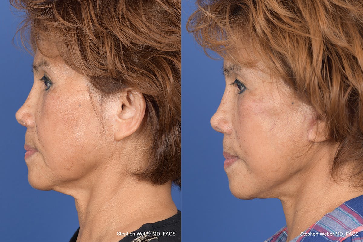 Facelift Before & After Gallery - Patient 306298 - Image 2