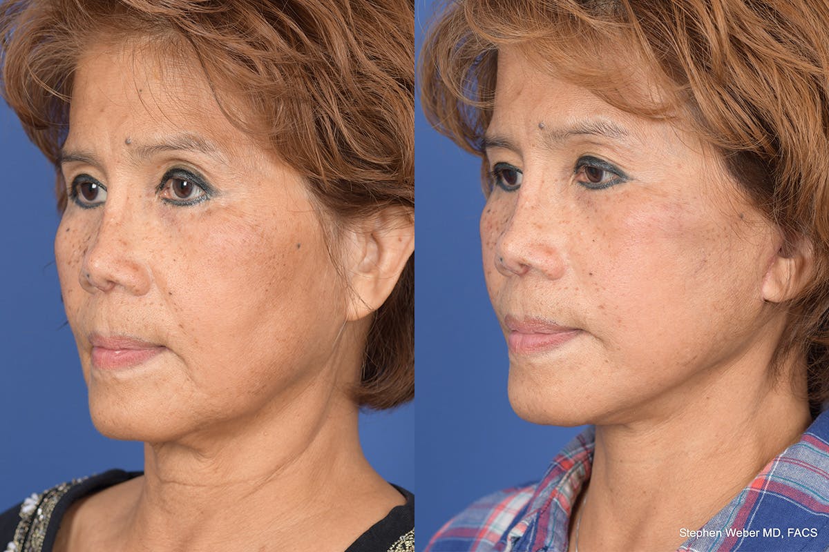 Facelift Before & After Gallery - Patient 306298 - Image 3