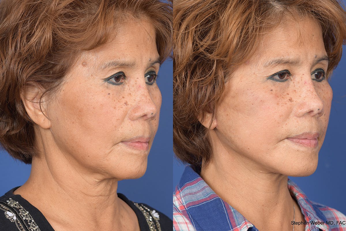 Facelift Before & After Gallery - Patient 306298 - Image 4