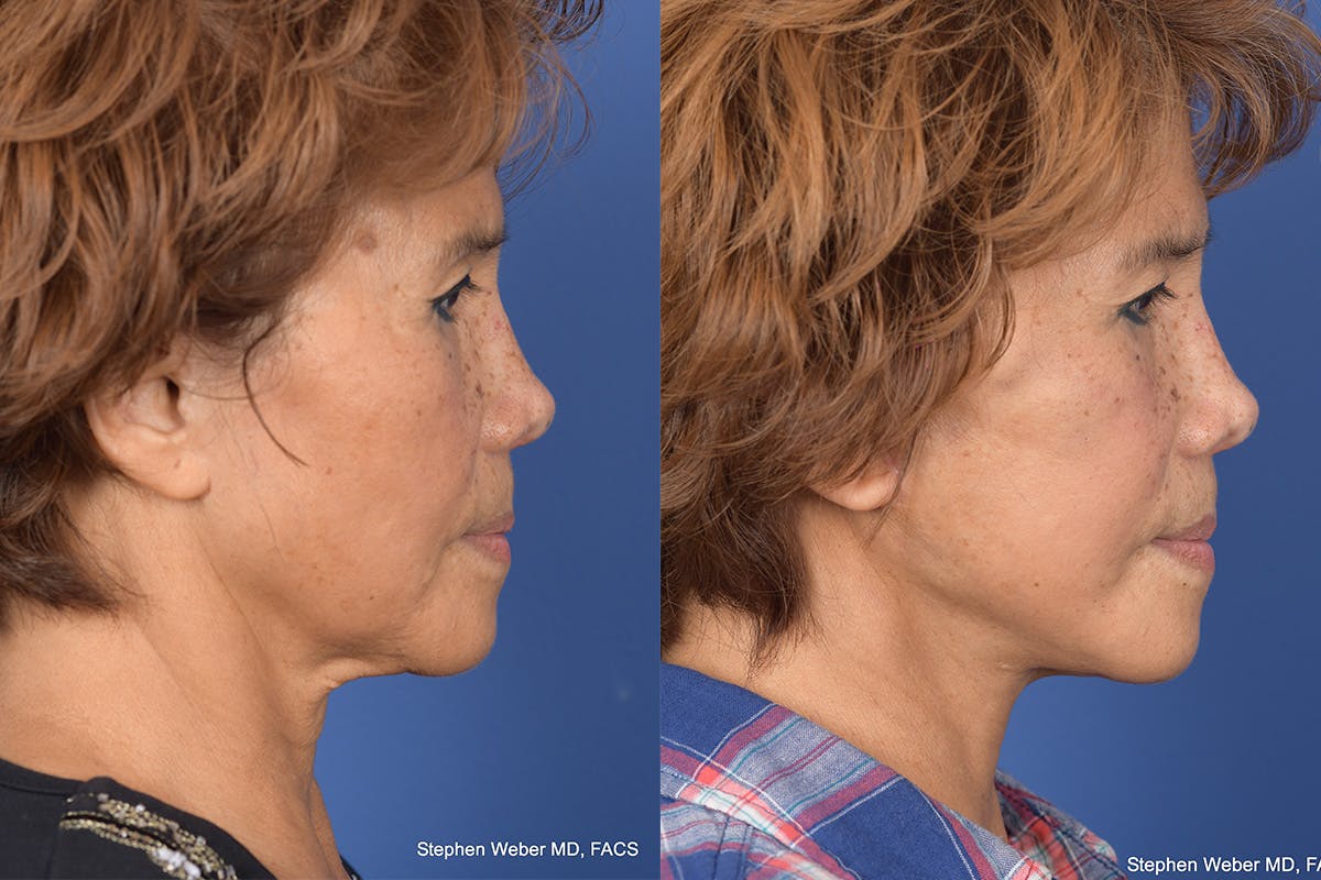 Facelift Before & After Gallery - Patient 306298 - Image 5