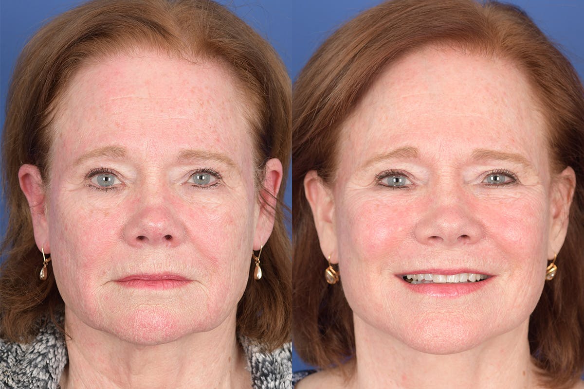 Facelift Before & After Gallery - Patient 157501 - Image 1