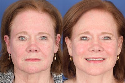 Facelift Before & After Gallery - Patient 157501 - Image 1