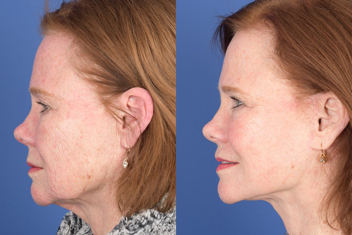 Facelift Before & After Gallery - Patient 157501 - Image 2