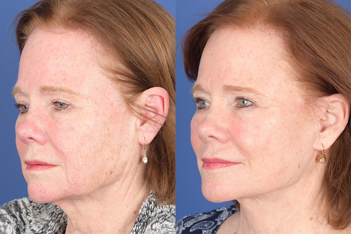 Facelift Before & After Gallery - Patient 157501 - Image 3