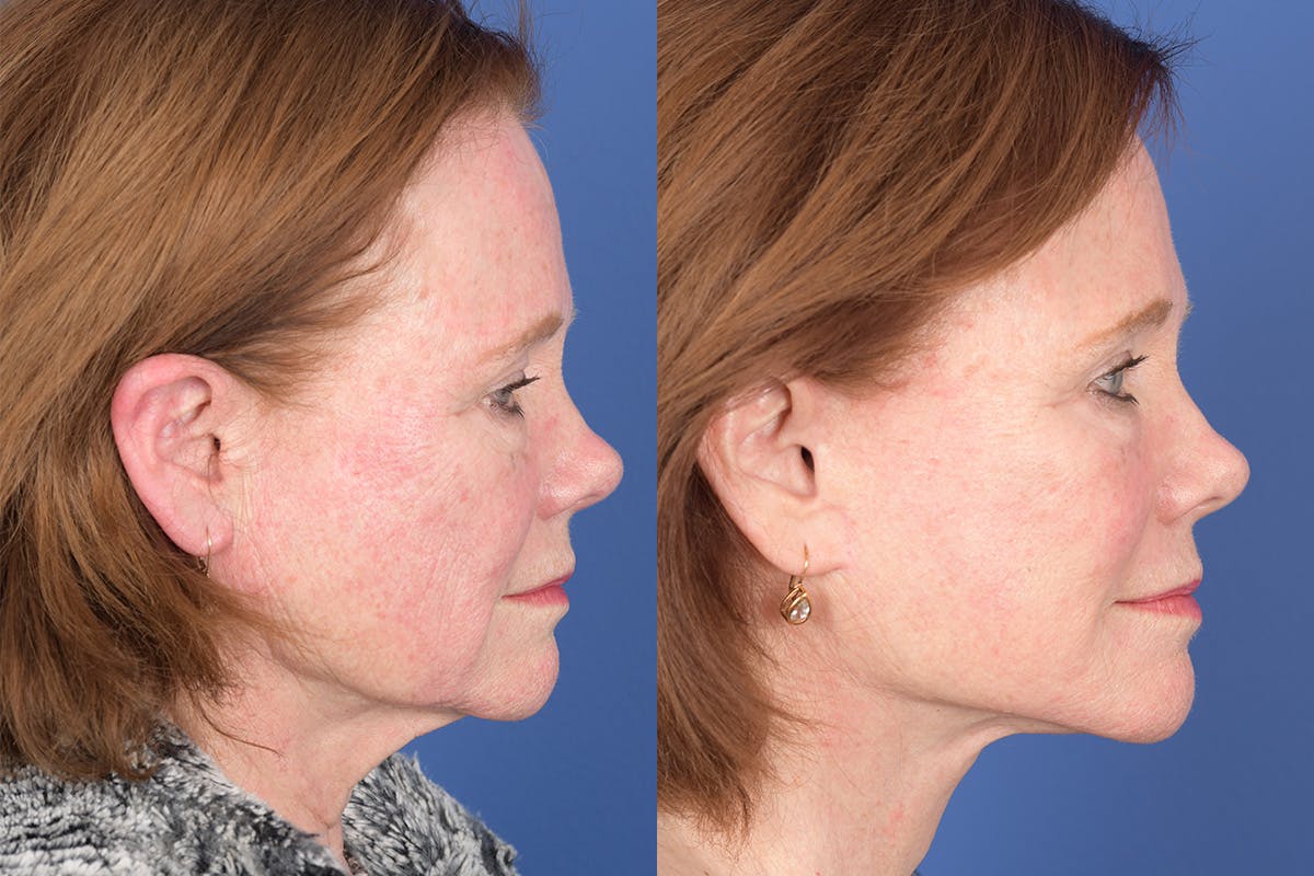 Facelift Before & After Gallery - Patient 157501 - Image 4