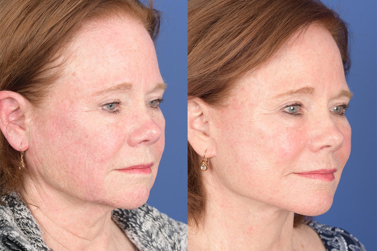 Facelift Before & After Gallery - Patient 157501 - Image 5