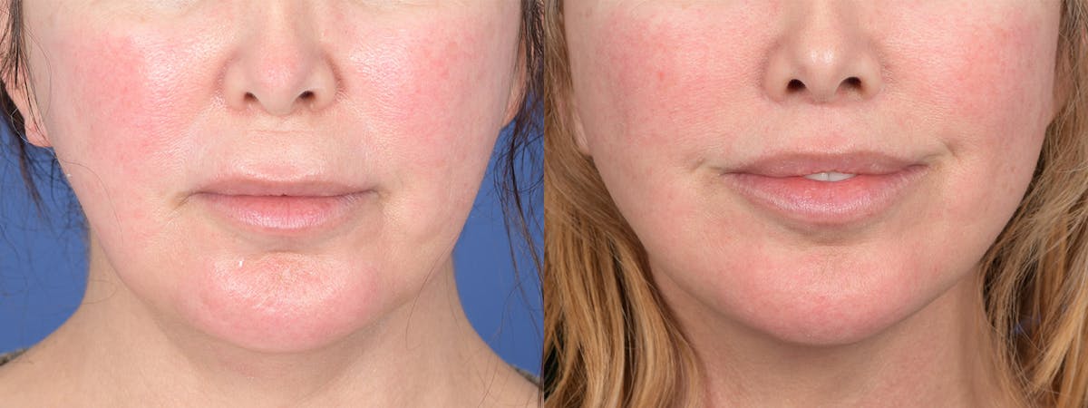 Facelift Before & After Gallery - Patient 311444 - Image 1