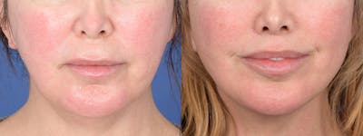 Facelift Before & After Gallery - Patient 311444 - Image 1