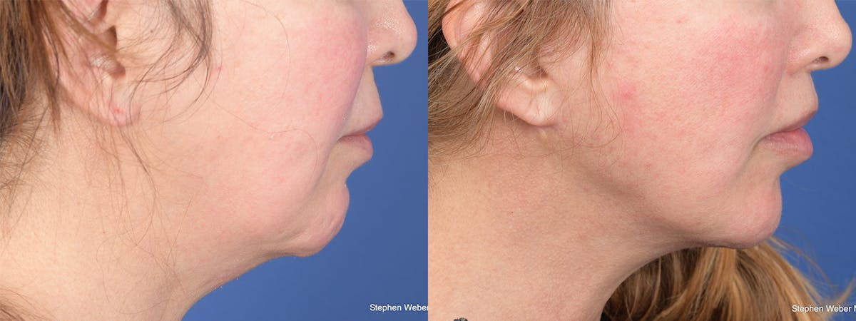 Facelift Before & After Gallery - Patient 311444 - Image 2