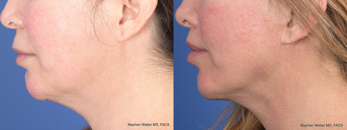 Facelift Before & After Gallery - Patient 311444 - Image 3