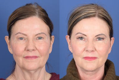 Facelift Before & After Gallery - Patient 368675 - Image 1